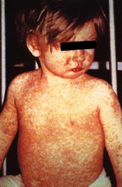 Child_measles