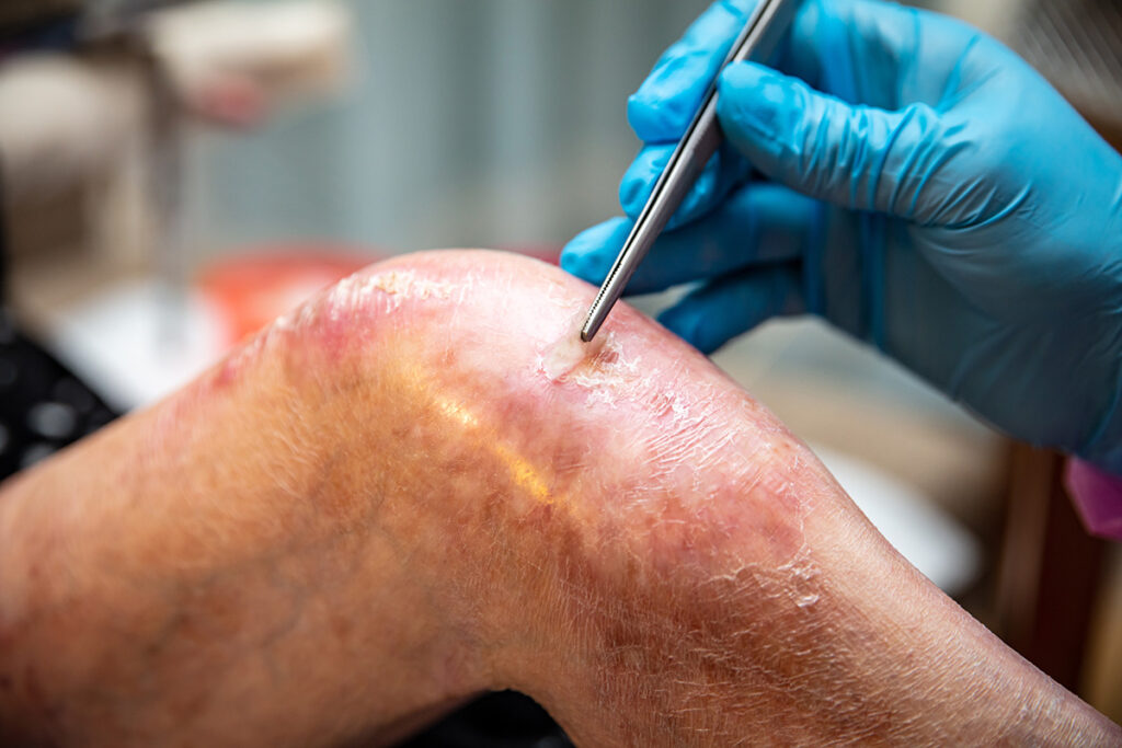 Doctor removing scab from a knee wound caused by Epidermolysis Bullosa using medical tools.