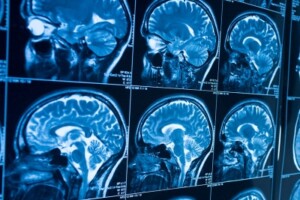image of a brain scan