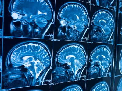 image of a brain scan