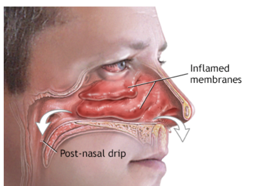The common cold causes sinus inflammation and post-nasal drip too